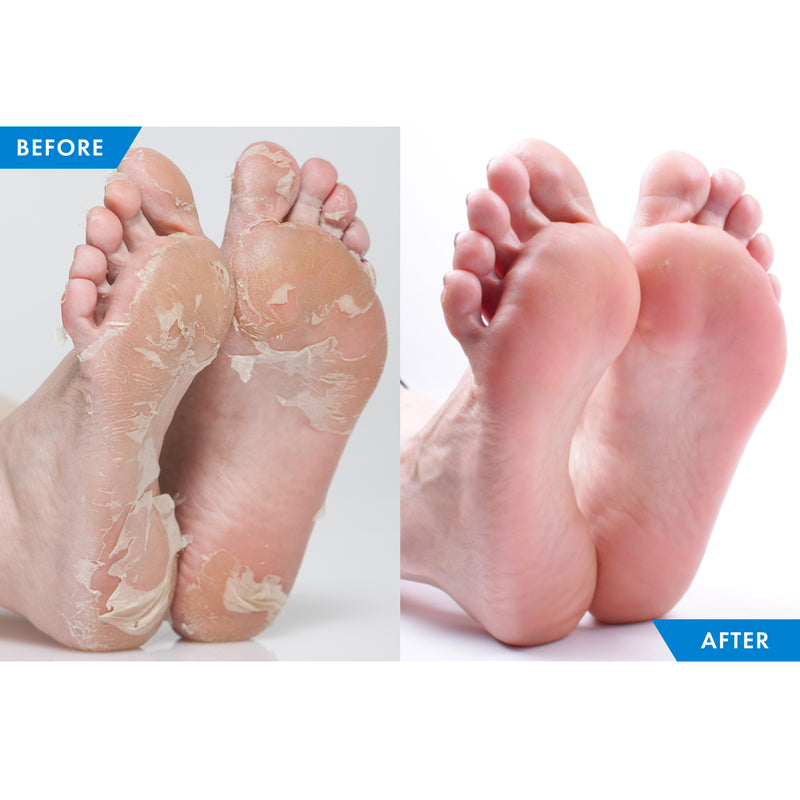 Foot Exfoliators: Reveal Silky Smooth Feet Instantly